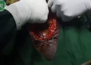 Women Who Towel Was Left Inside Belly During Operation Dies