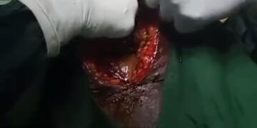 Women Who Towel Was Left Inside Belly During Operation Dies