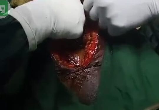 Women Who Towel Was Left Inside Belly During Operation Dies