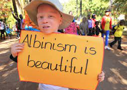 Discrimination against Albinos on the rise – NAPA