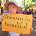 Discrimination against Albinos on the rise – NAPA