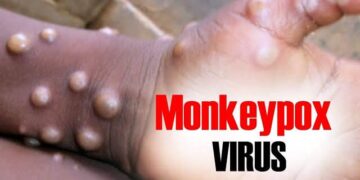 Mpox still not under control in Africa – Africa CDC